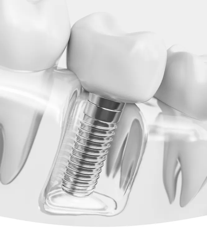 Dental Implants