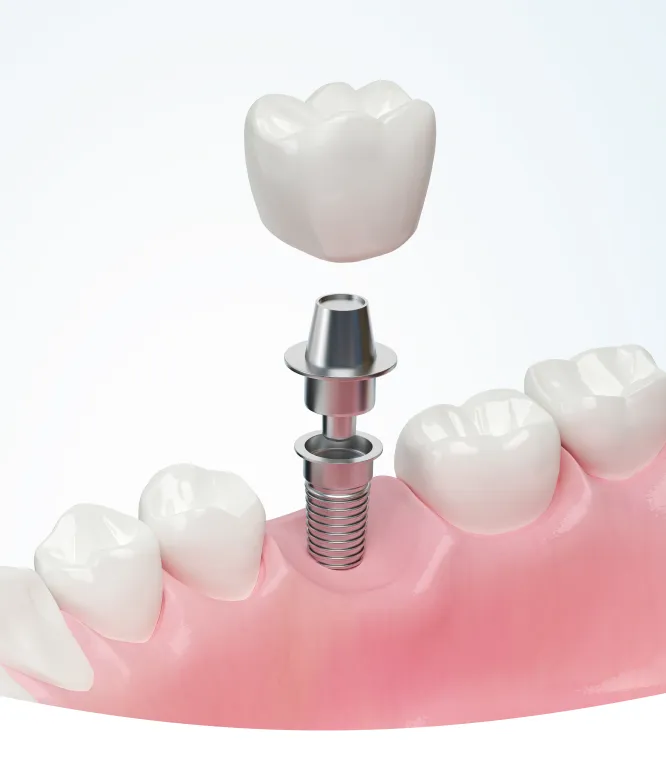 Dental Implants