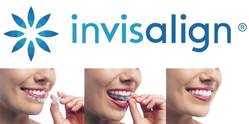 Invisalign smile photo